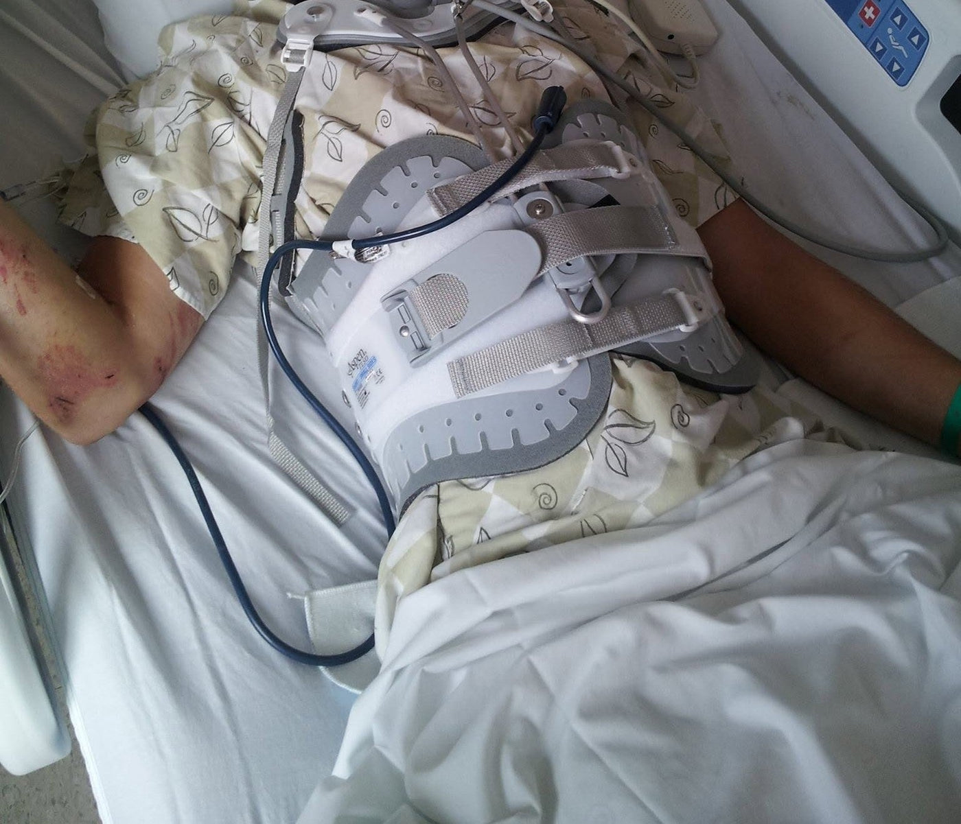Hospital bed after a severe motorcycle accident — cervical collar and full back brace, road rash on the arm
